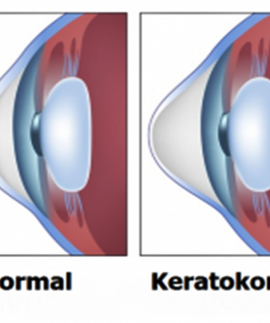 Keratokonus Lens